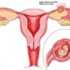 ectopic pregnancy